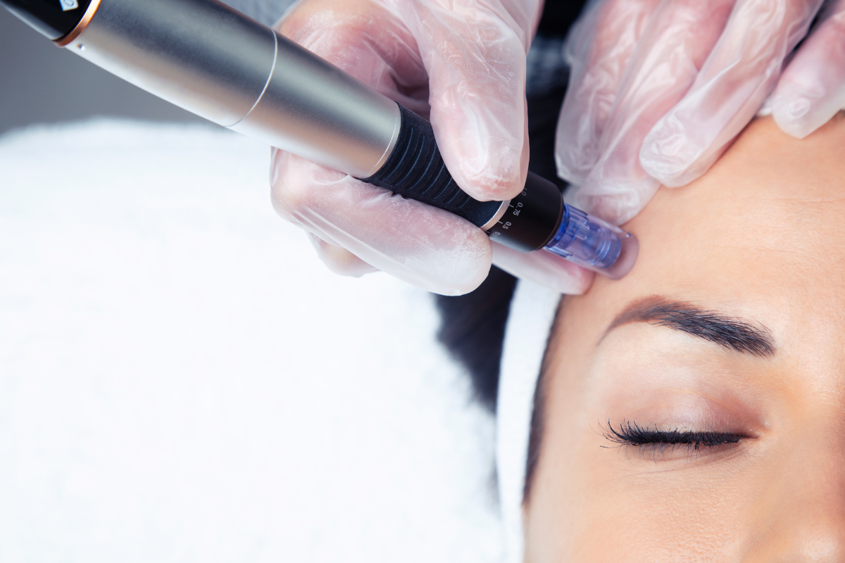 Microneedling Gesichtsbehandlung bei Zauberhaft Kosmetik mit Hyaluronsäure
