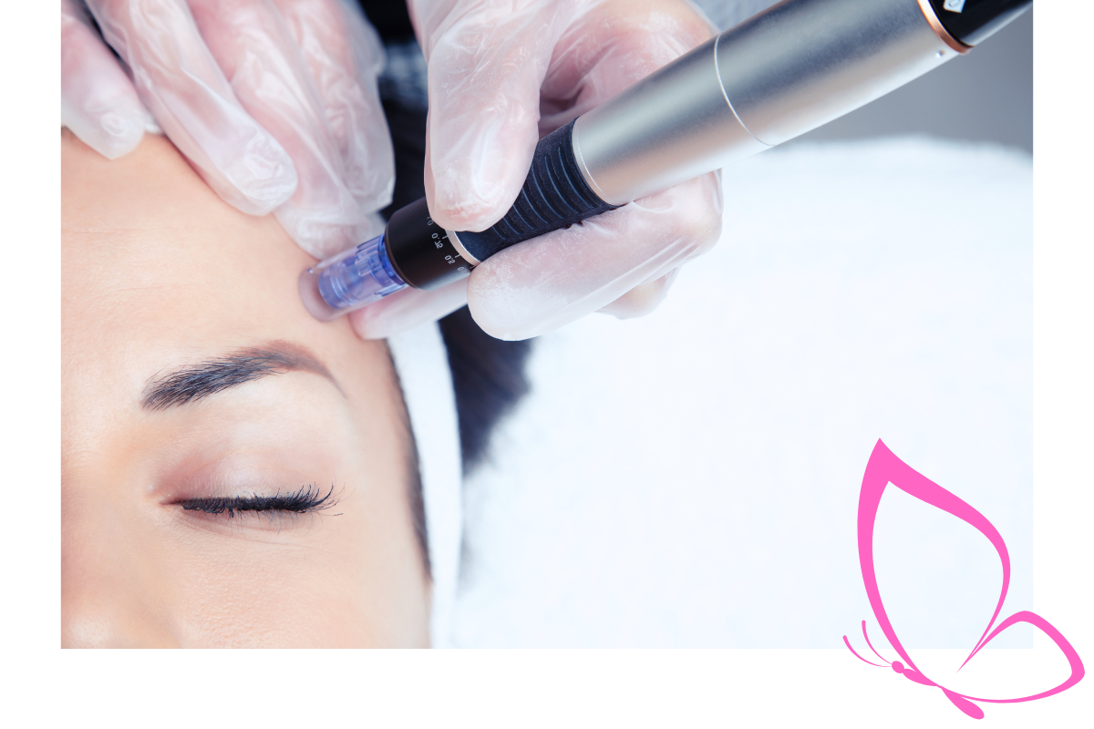 Microneedling Gesichtsbehandlung bei Zauberhaft Kosmetik mit Hyaluronsäure